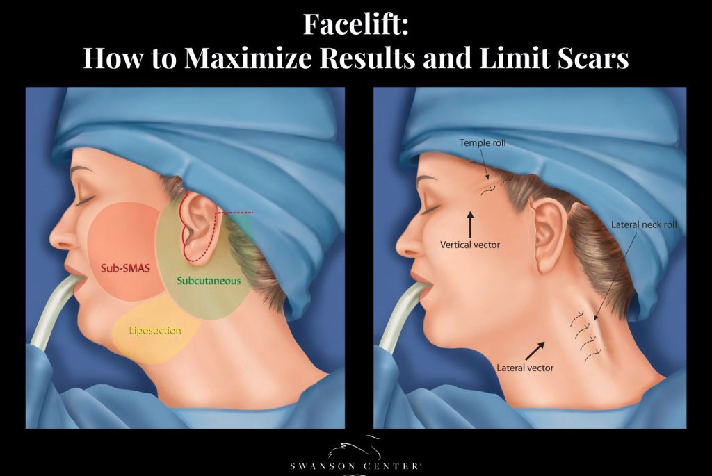 Facelift How to Maximize Results and Limit Scars