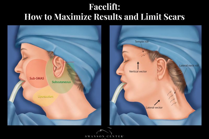 Facelift How to Maximize Results and Limit Scars