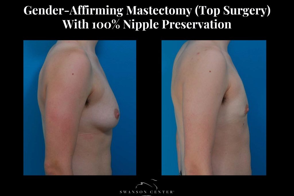 Gender-Affirming Mastectomy (Top Surgery) With 100% Nipple Preservation